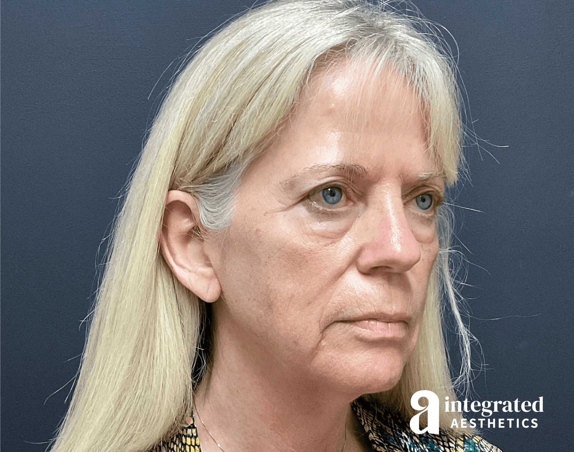Facelift & Neck Lift