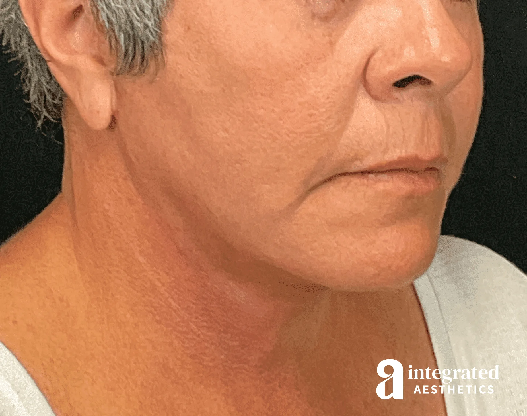 Facelift & Neck Lift