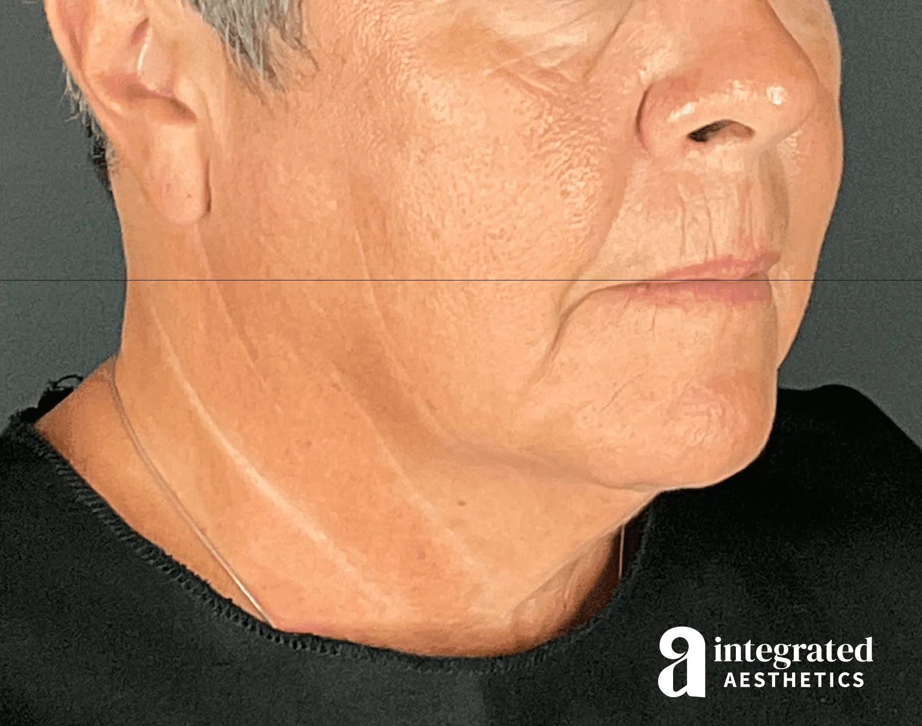 Facelift & Neck Lift