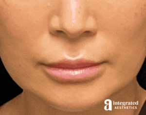 Lip Lift