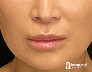 Lip Lift