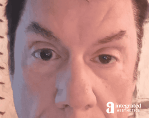 Resolved Aesthetic Complications