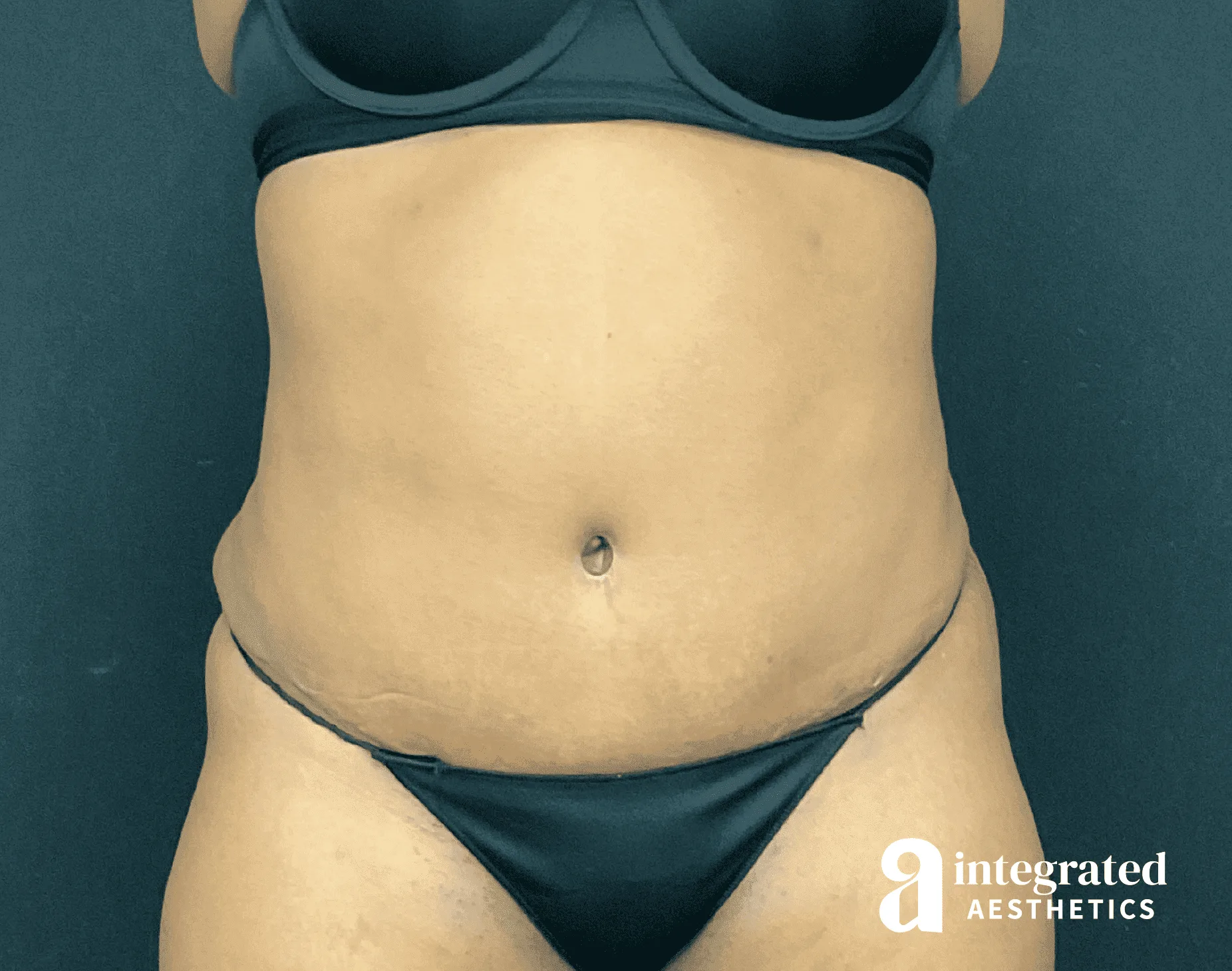 Tummy Tuck