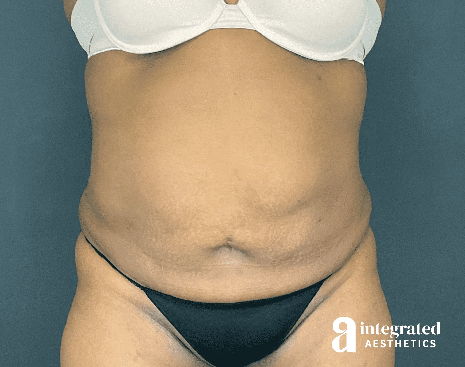 Tummy Tuck