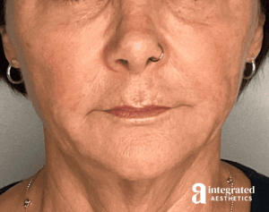 Dermal Fillers