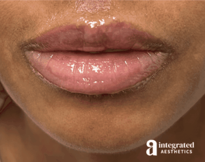 Lip Filler