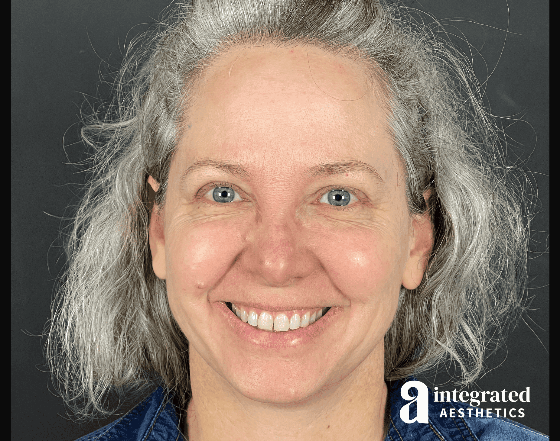 Before & after IPL photofacial treatment at Integrated Aesthetics