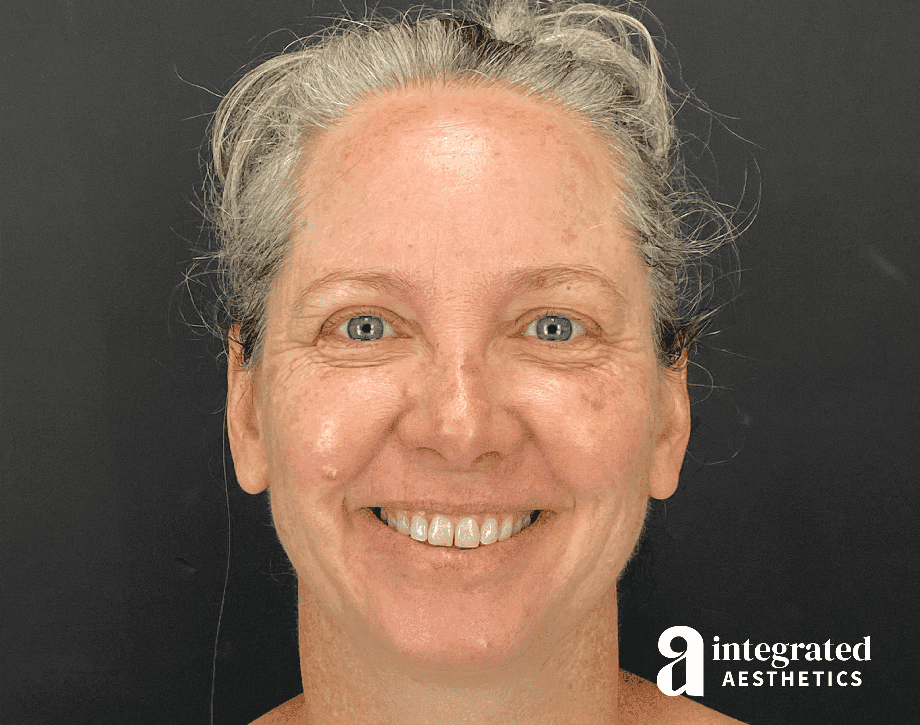 Before & after IPL photofacial treatment at Integrated Aesthetics