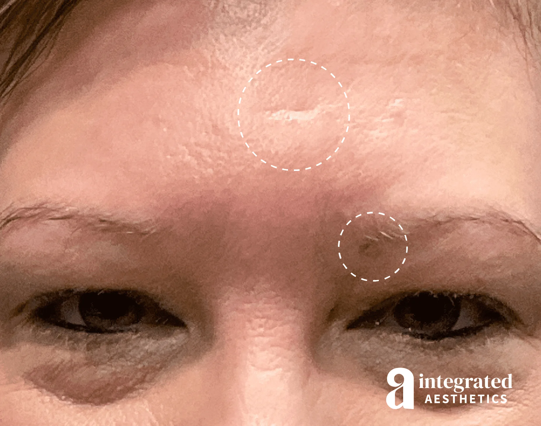 Cysts/Lipomas