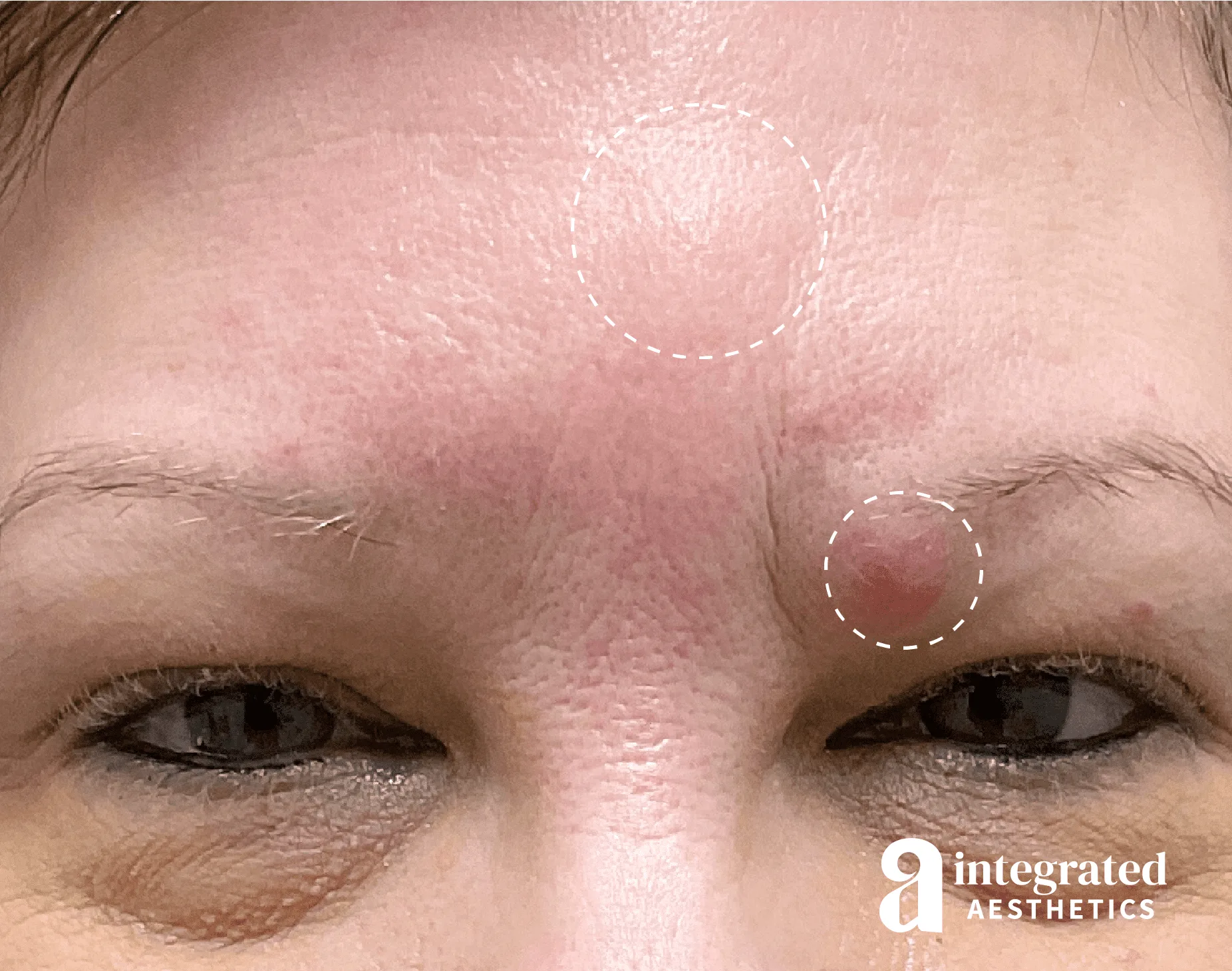 Cysts/Lipomas