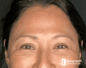 Wrinkle Relaxers