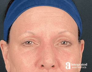Wrinkle Relaxers