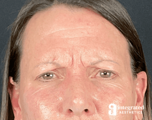 Dermal Fillers