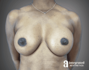 Breast Augmentation