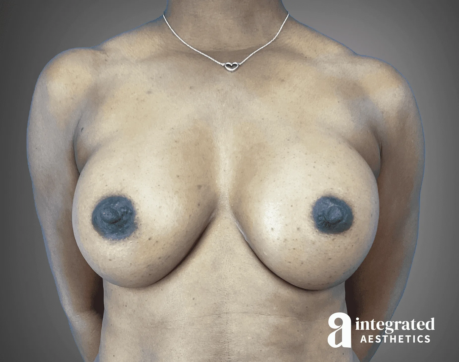 Breast Augmentation