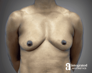 Breast Augmentation