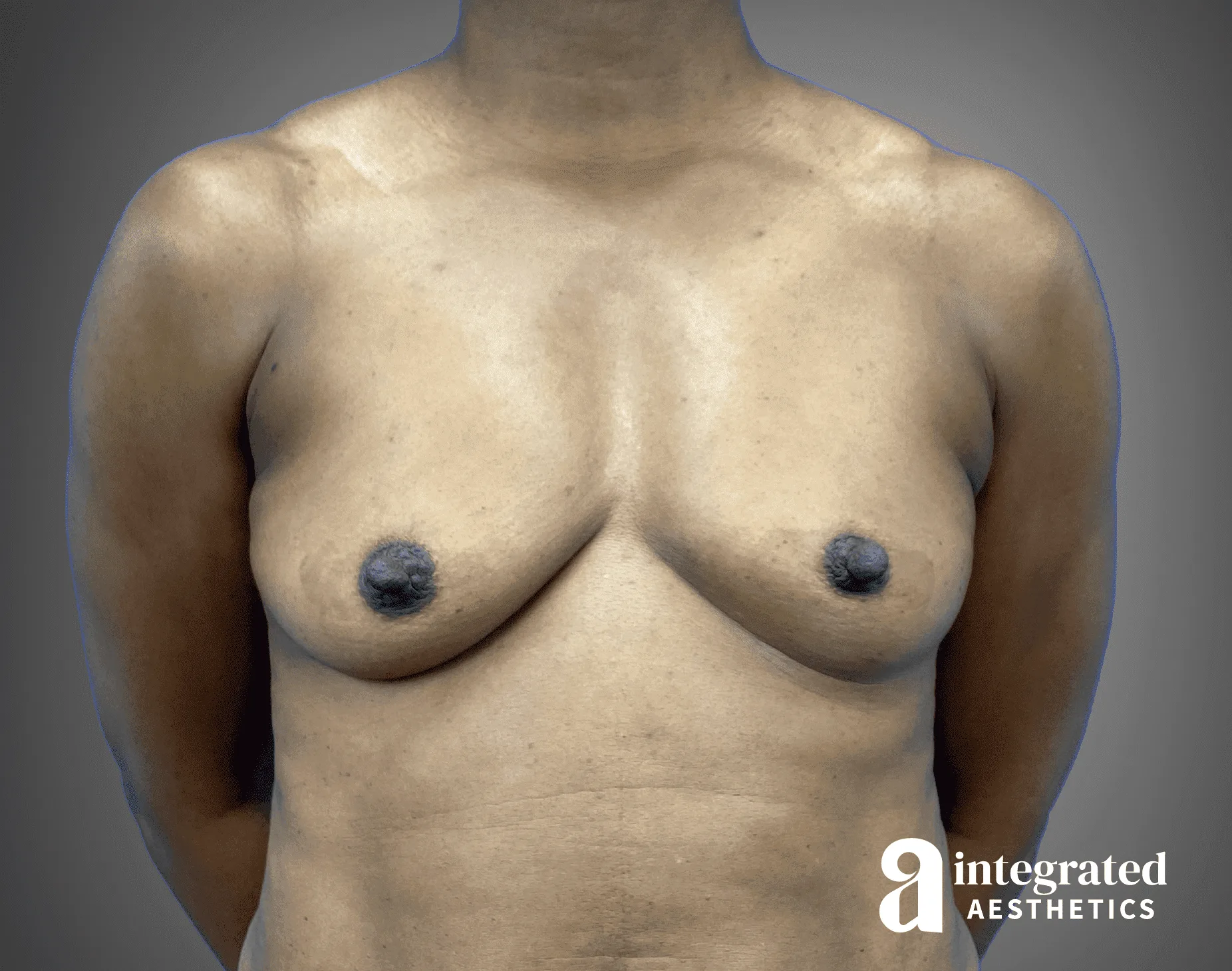Breast Augmentation