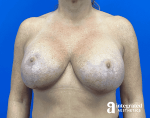 Breast Augmentation