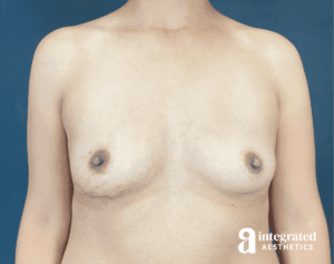Breast Augmentation