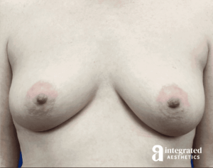 Breast Augmentation