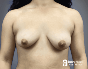 Breast Augmentation