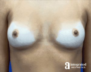 Breast Augmentation