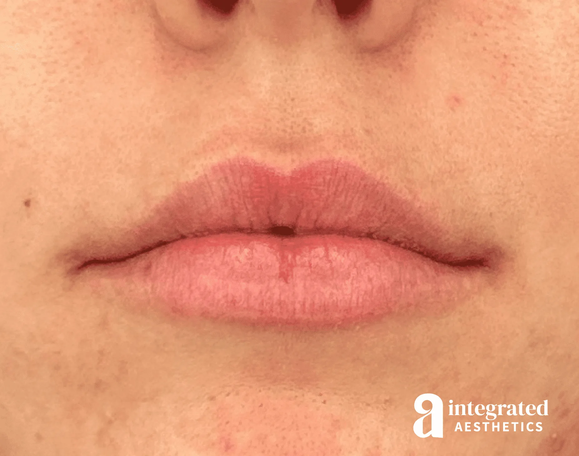 Lip Filler