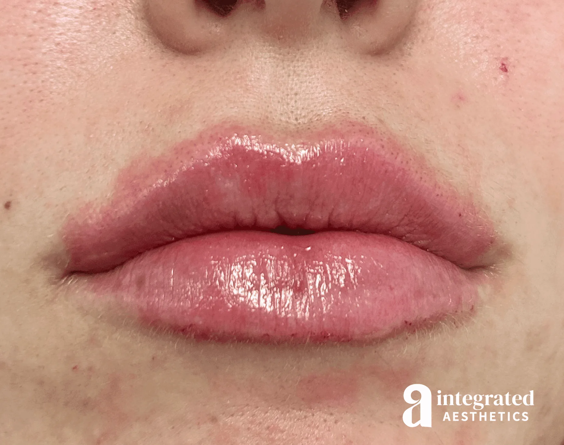 Lip Filler
