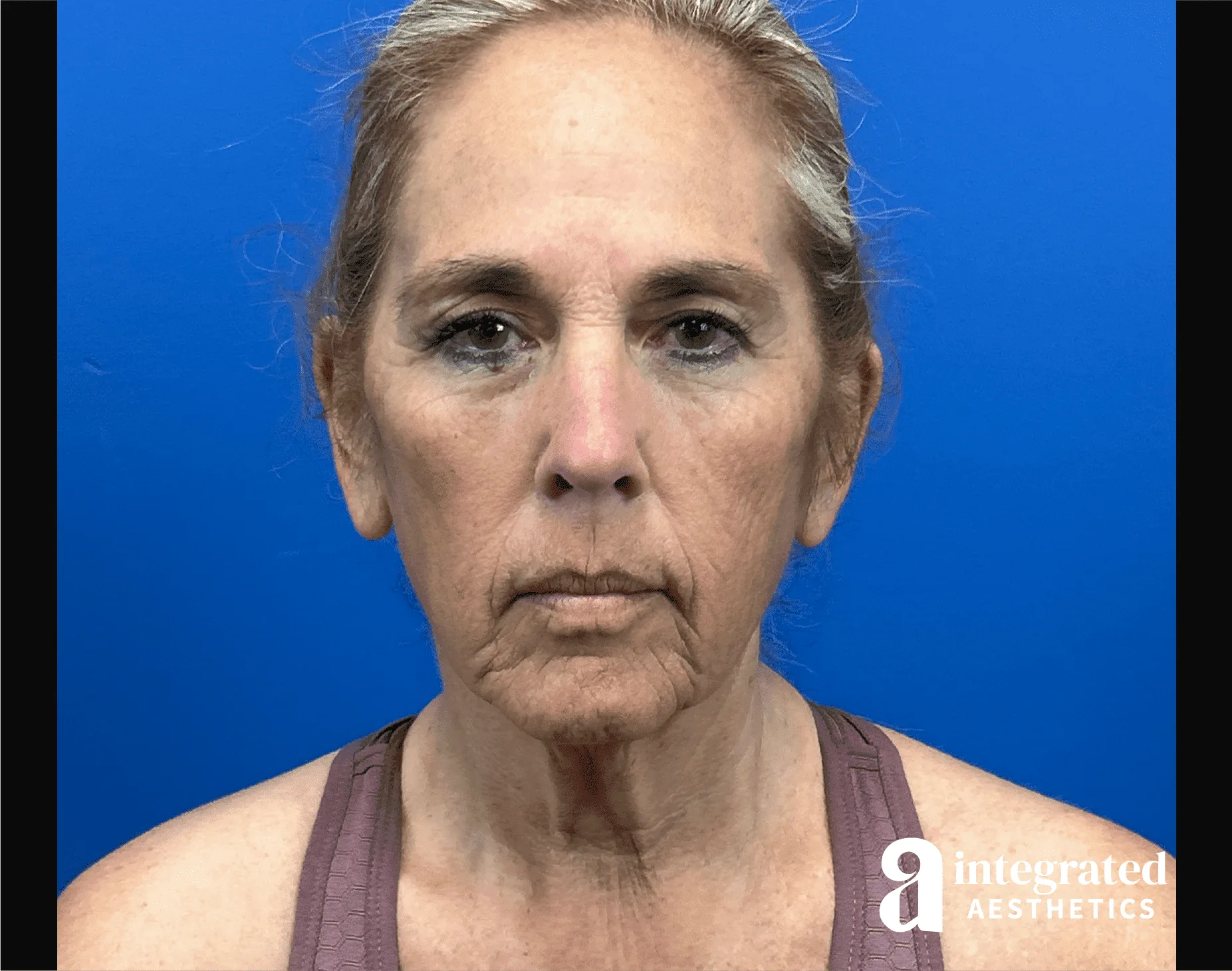 Facelift & Neck Lift