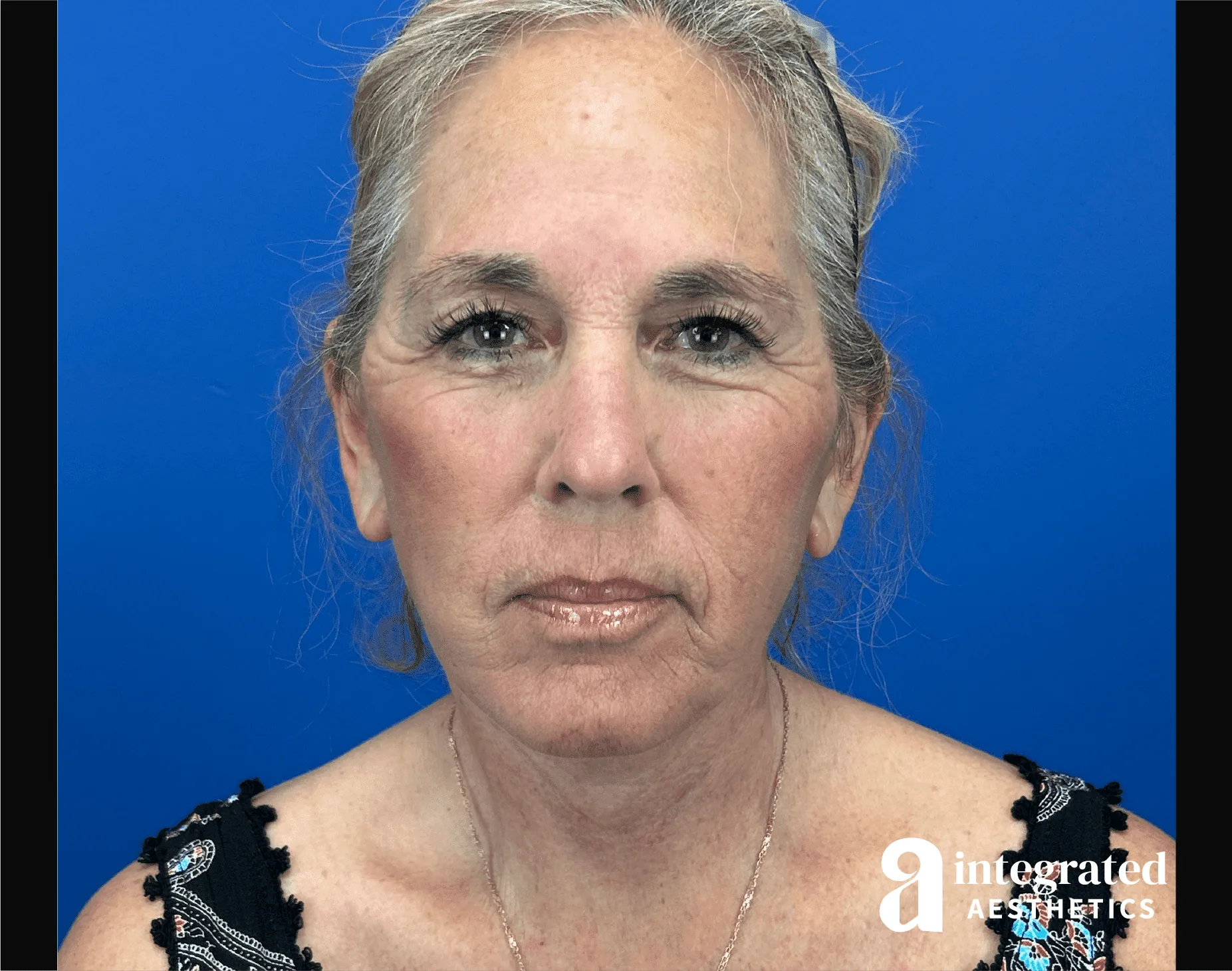Facelift & Neck Lift