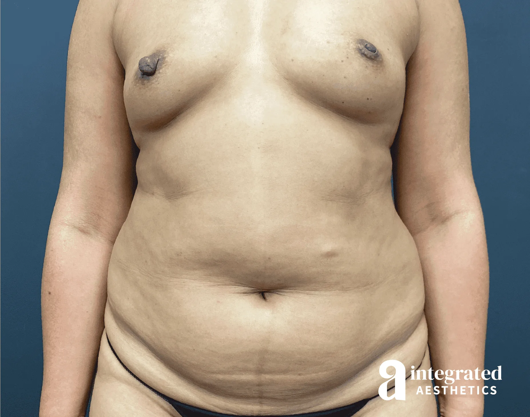 Tummy Tuck