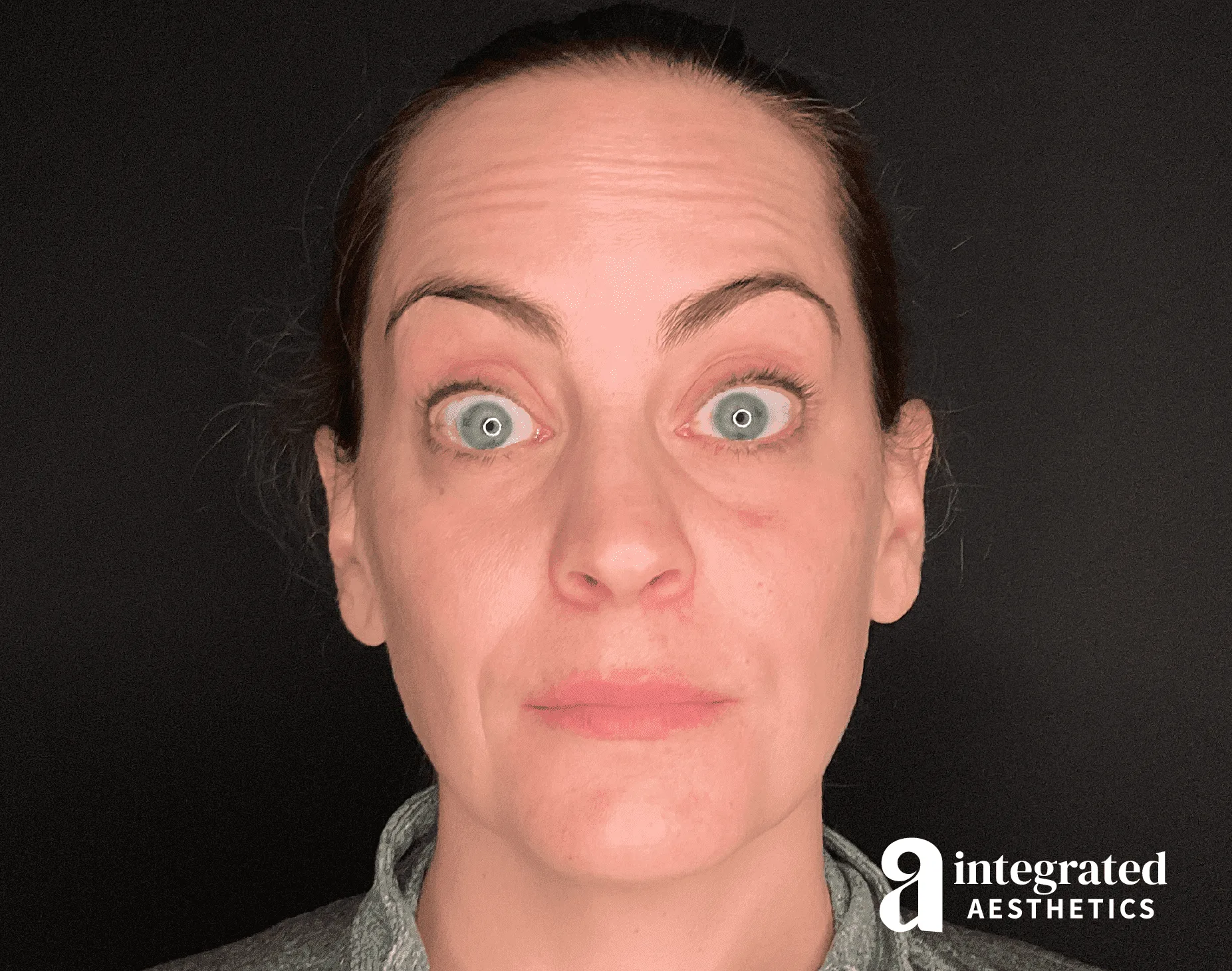 Sculptra