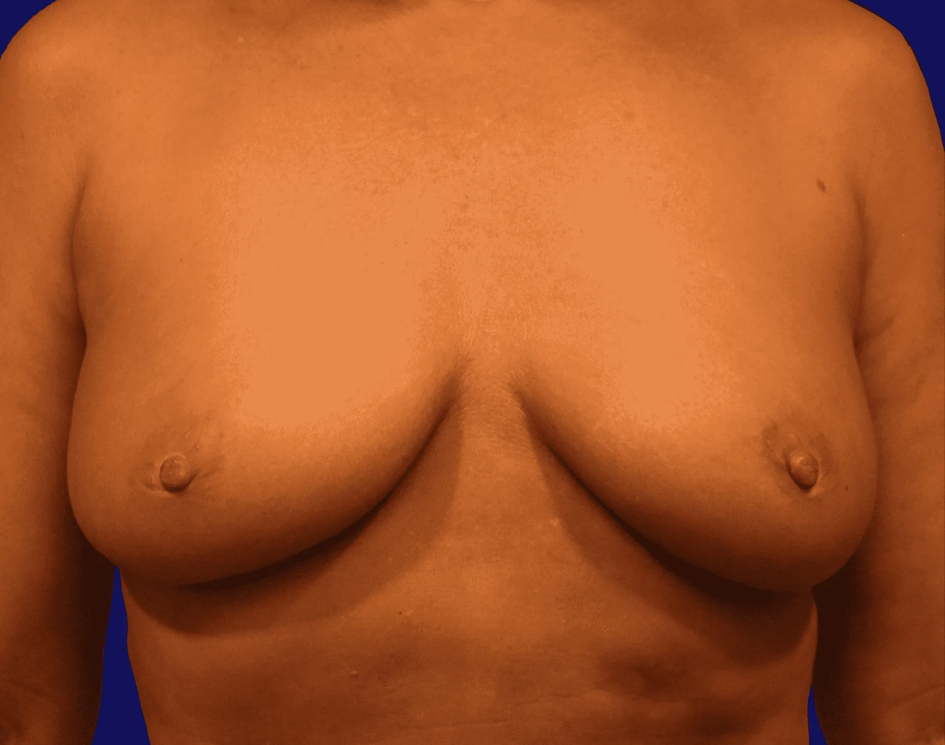 Breast Augmentation