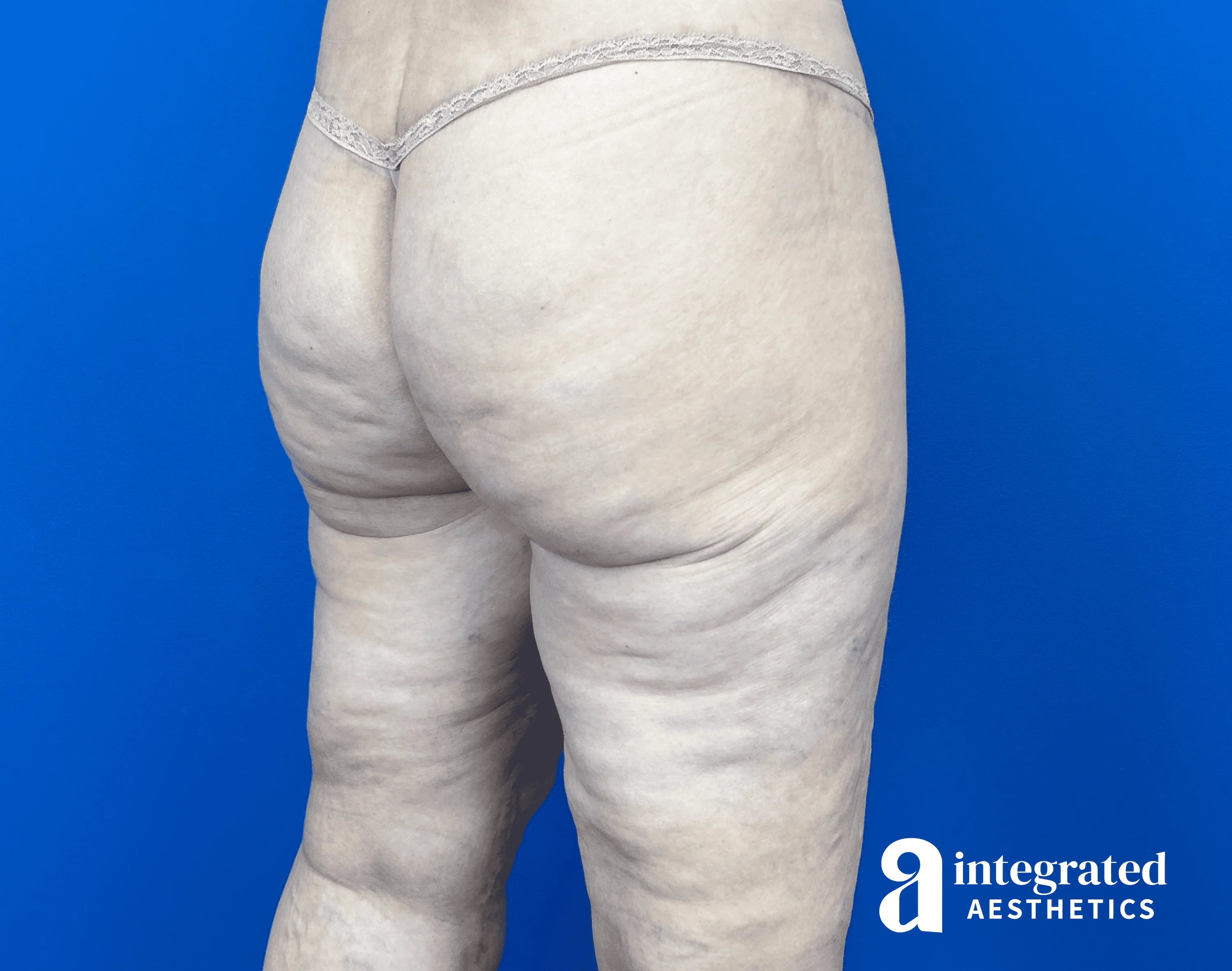 Thigh Lift