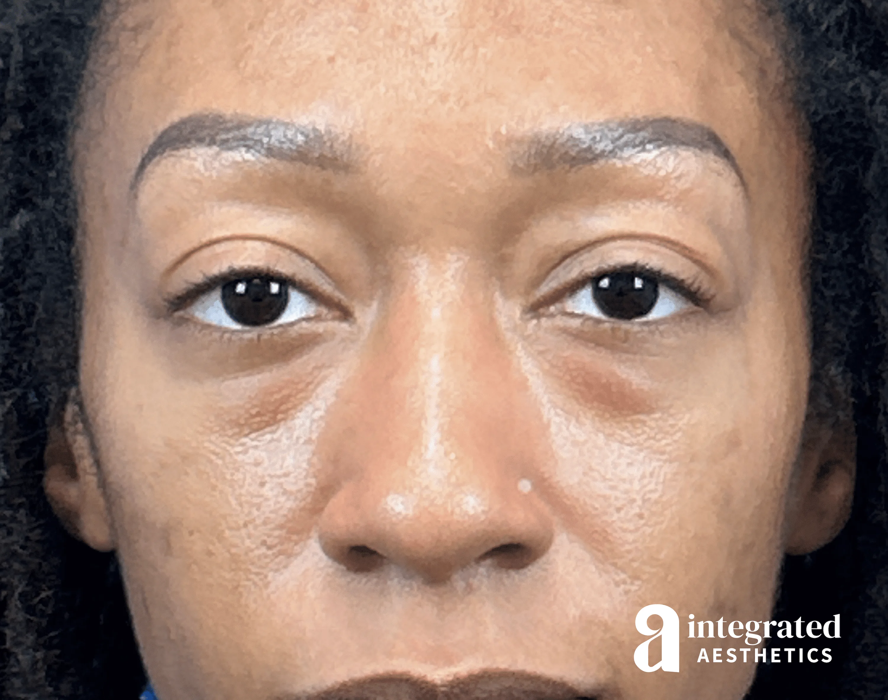 Blepharoplasty