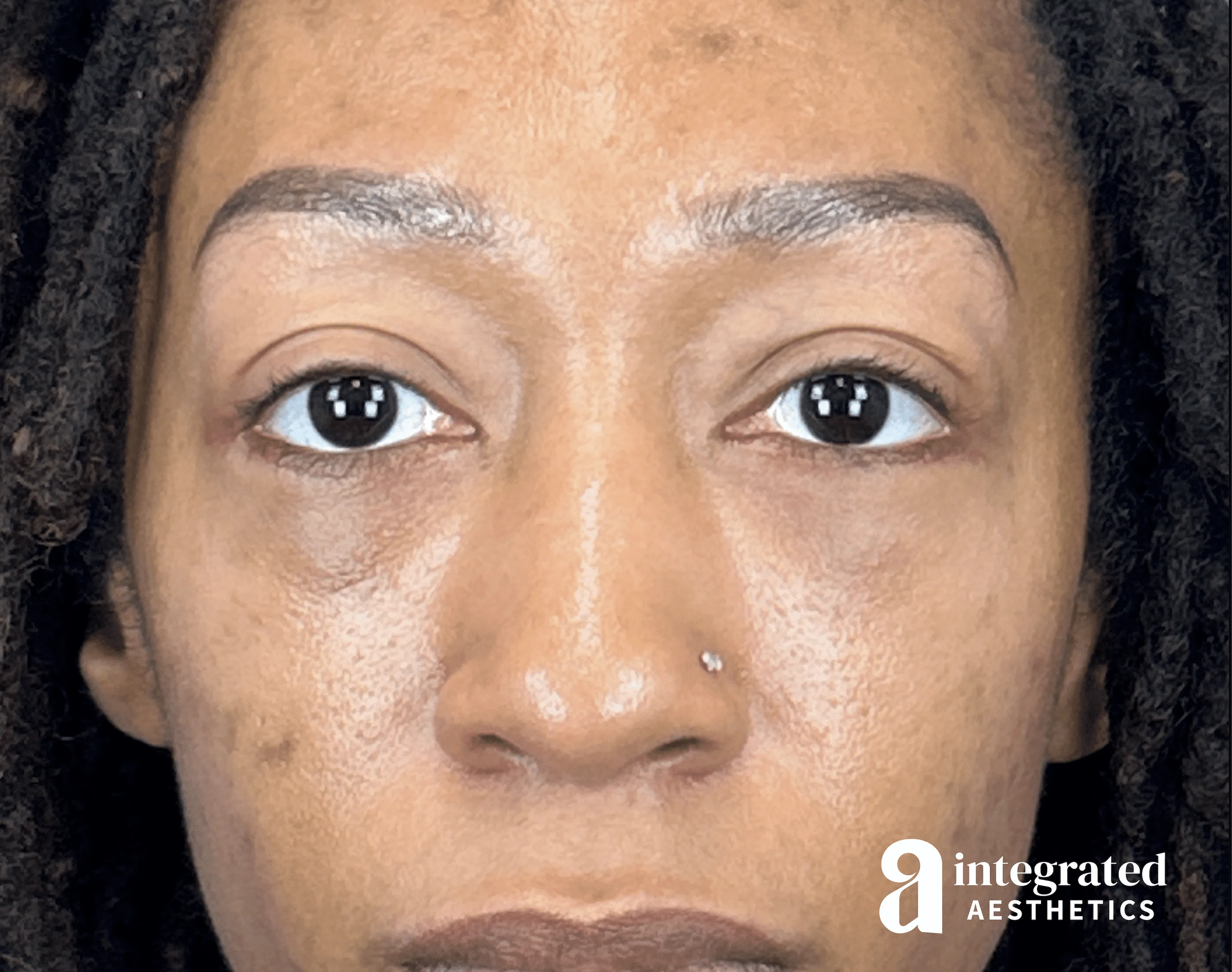 Blepharoplasty