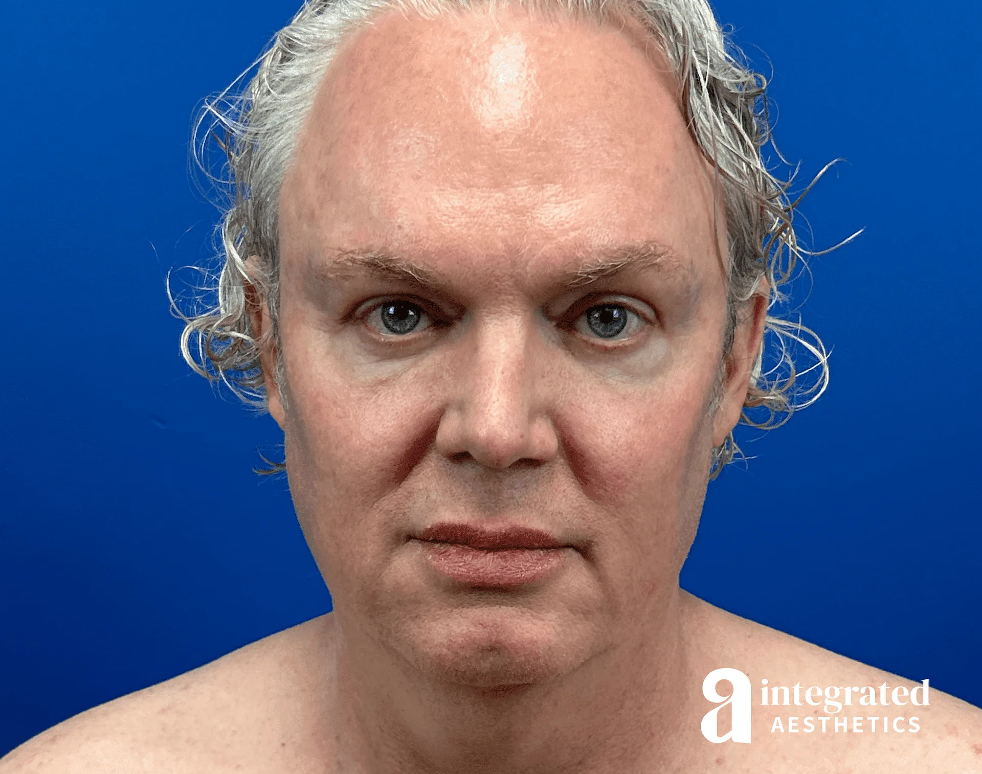 Facelift & Neck Lift