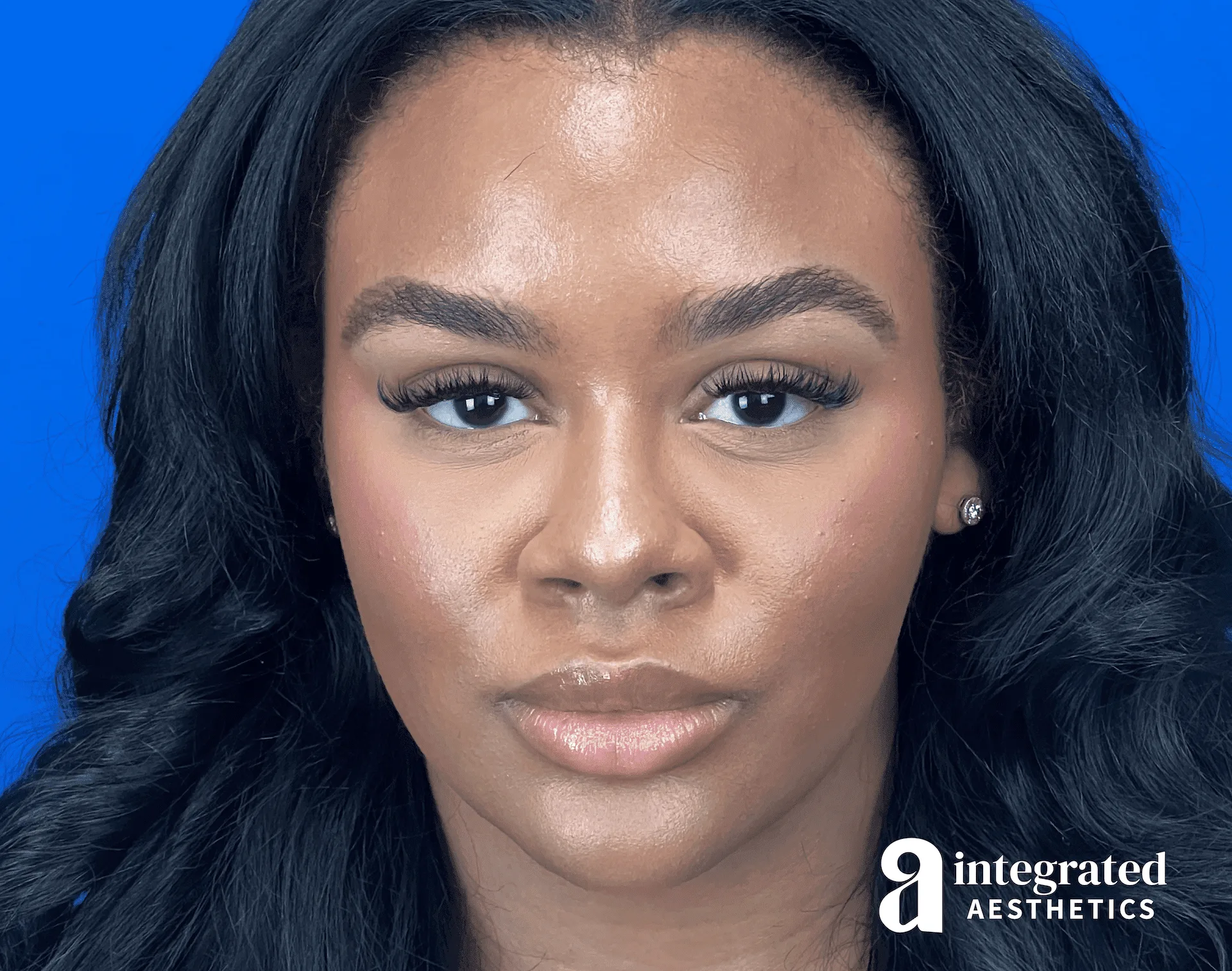 Dermal Fillers Before & After Gallery - Patient 169144 - Image 2