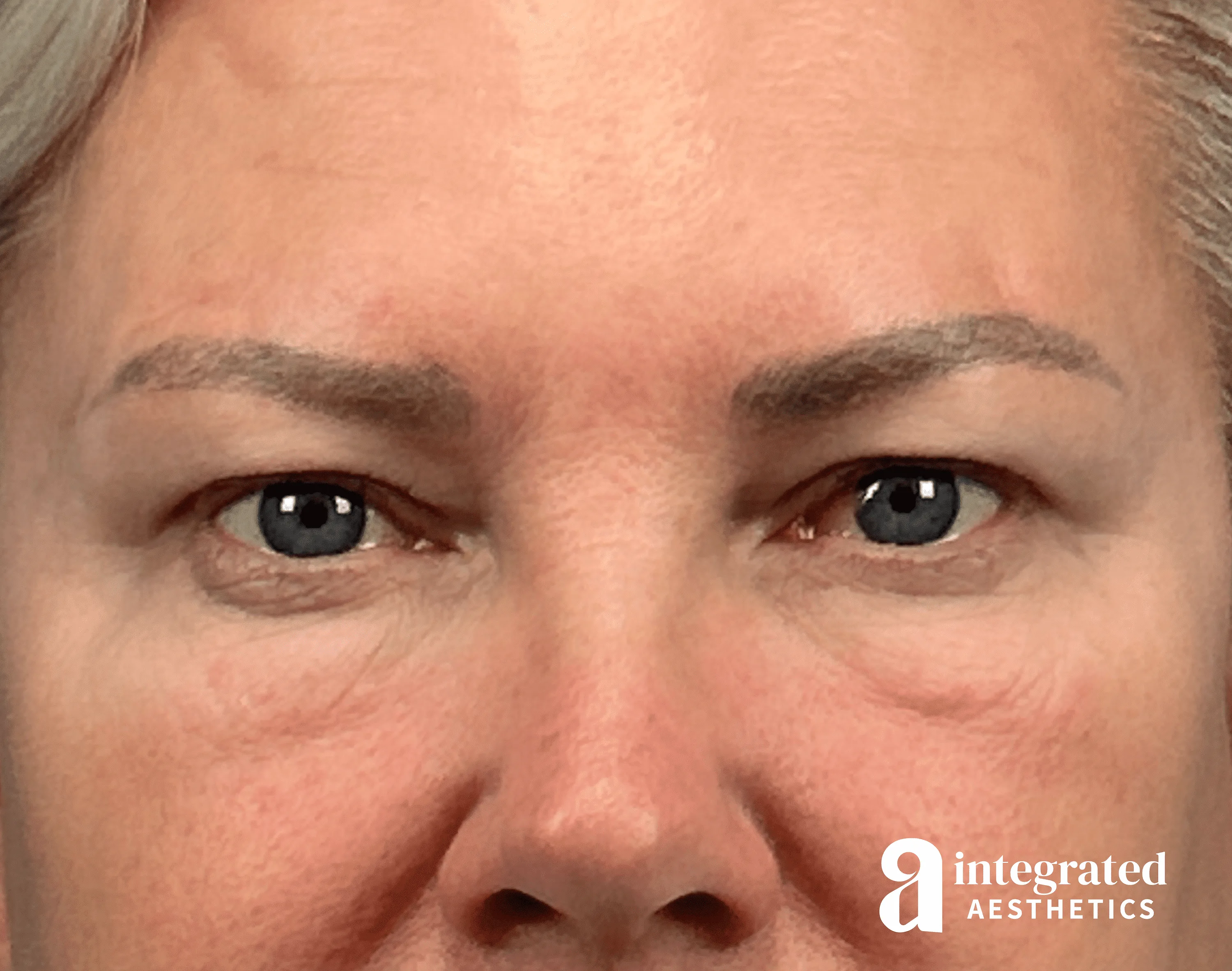 Blepharoplasty