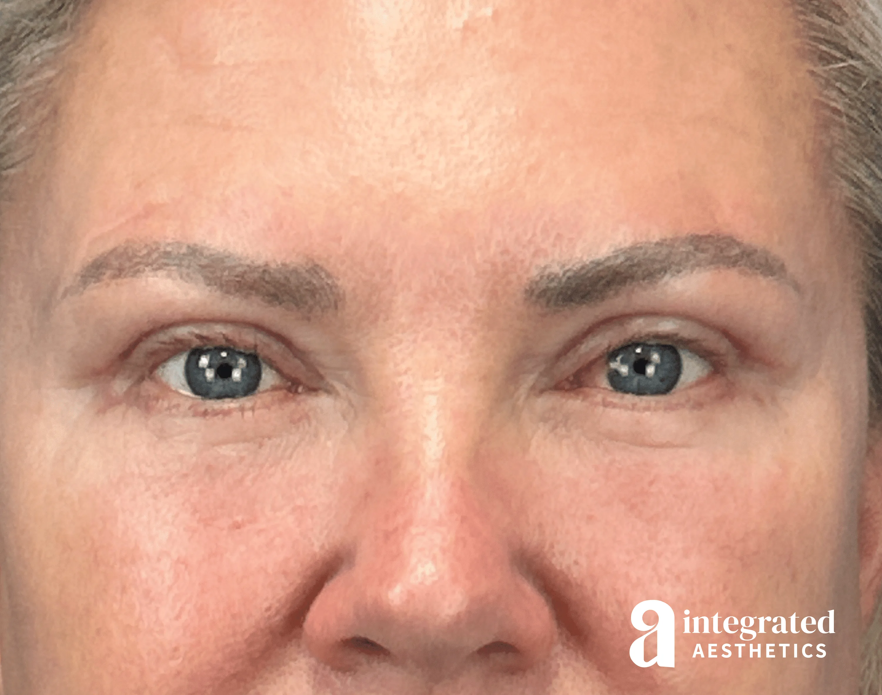 Blepharoplasty