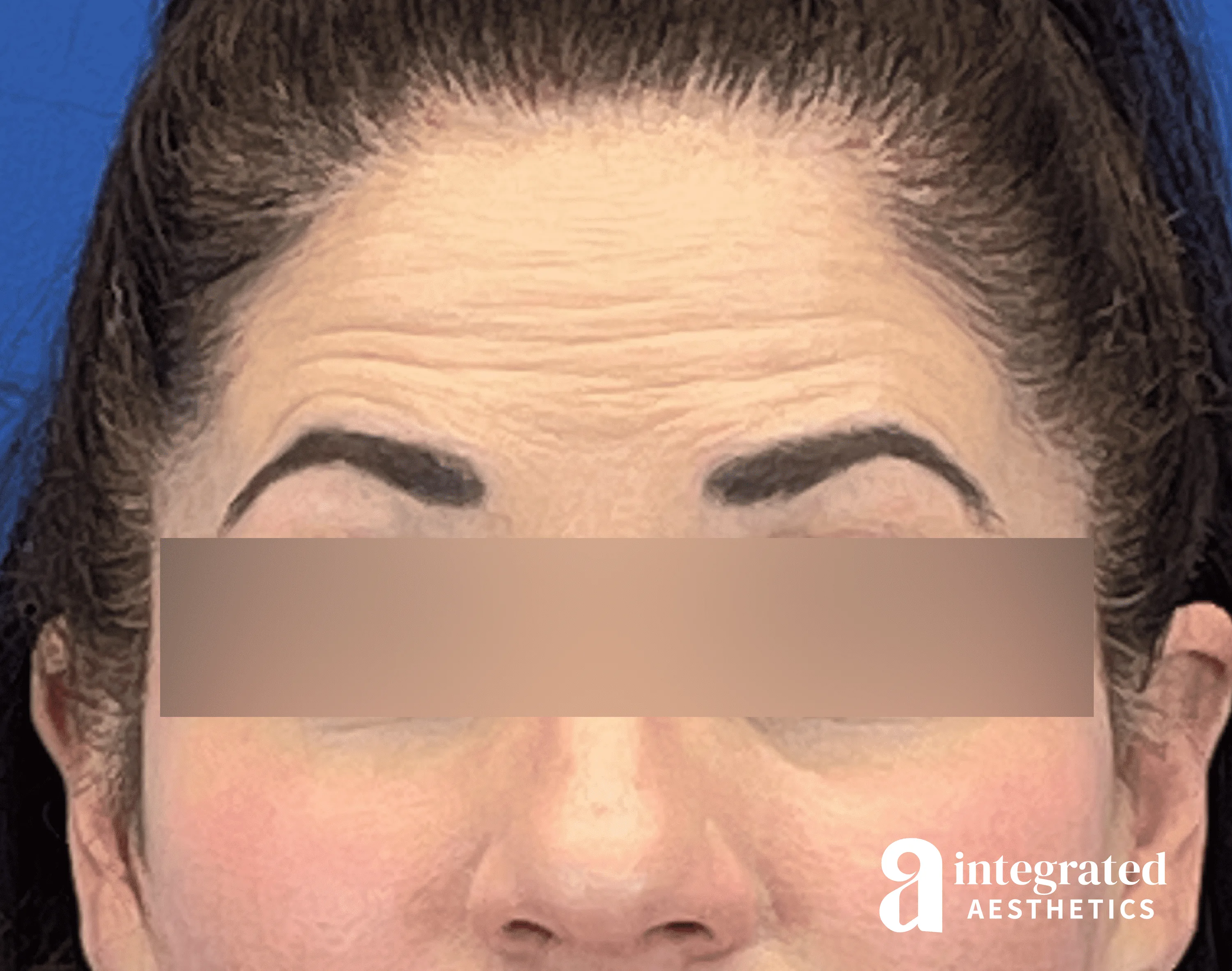 Botox