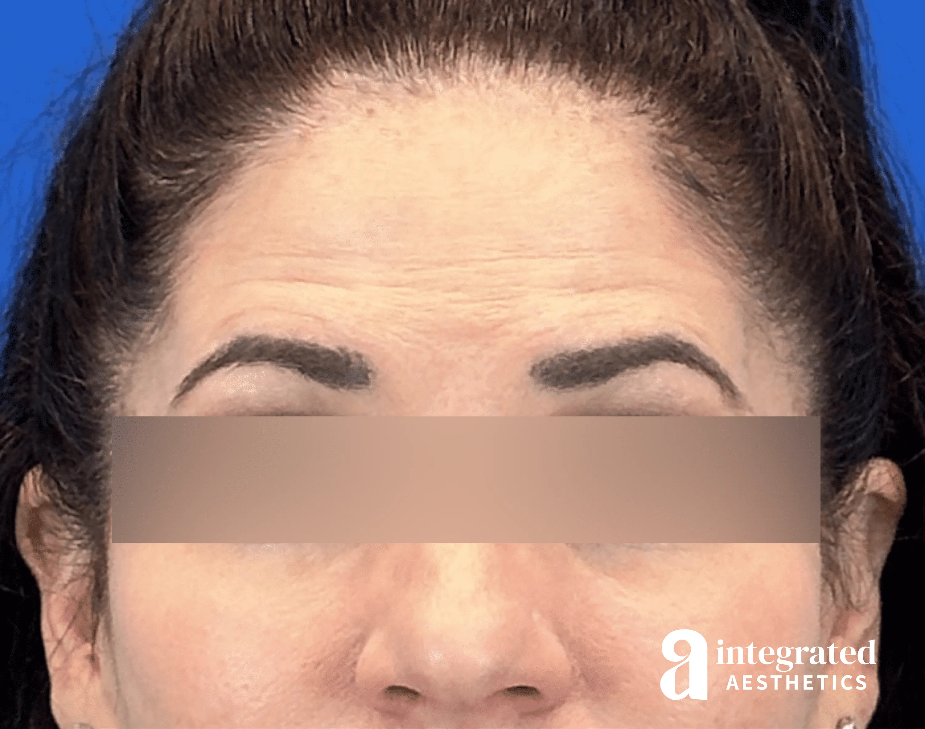 Botox