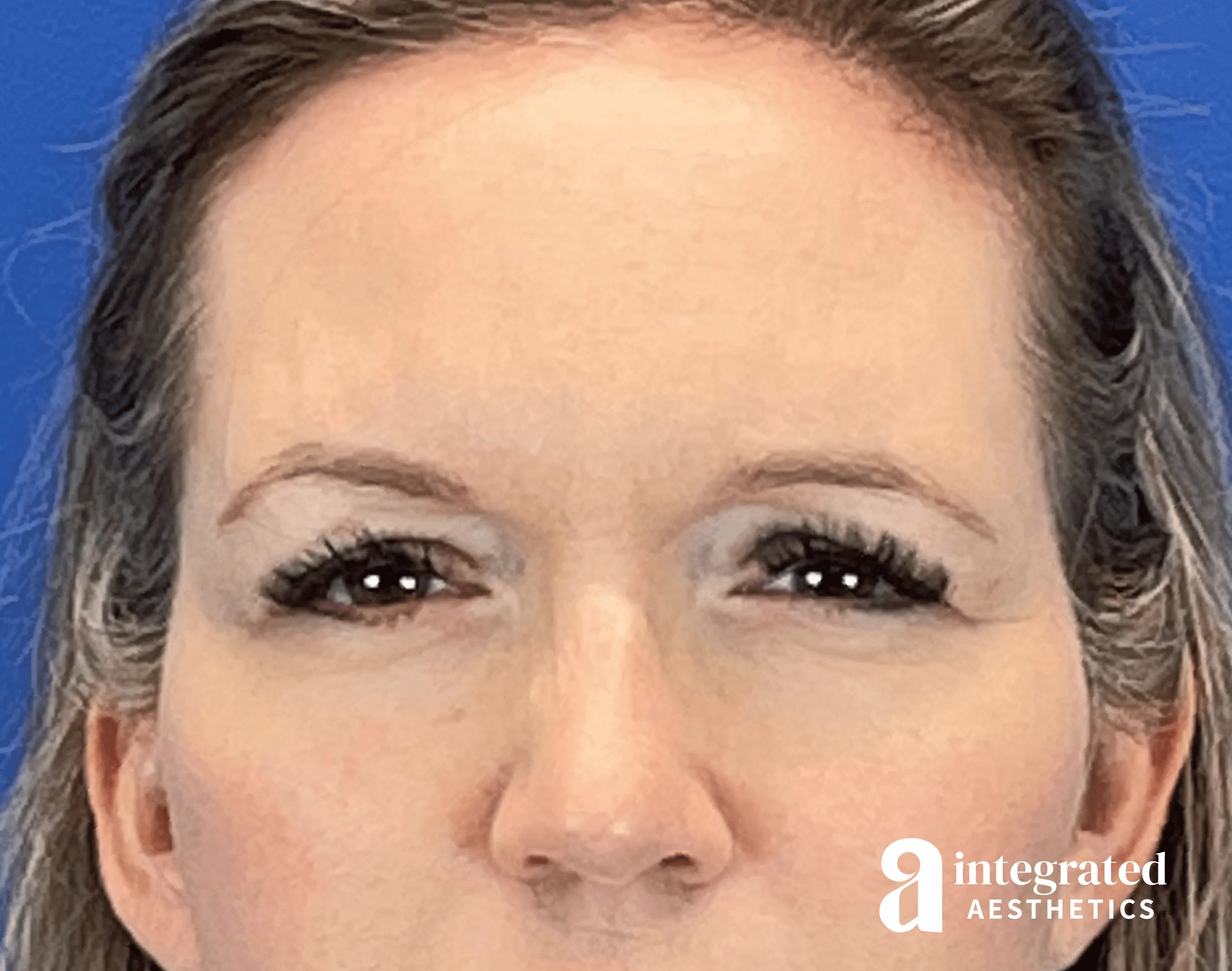 Botox