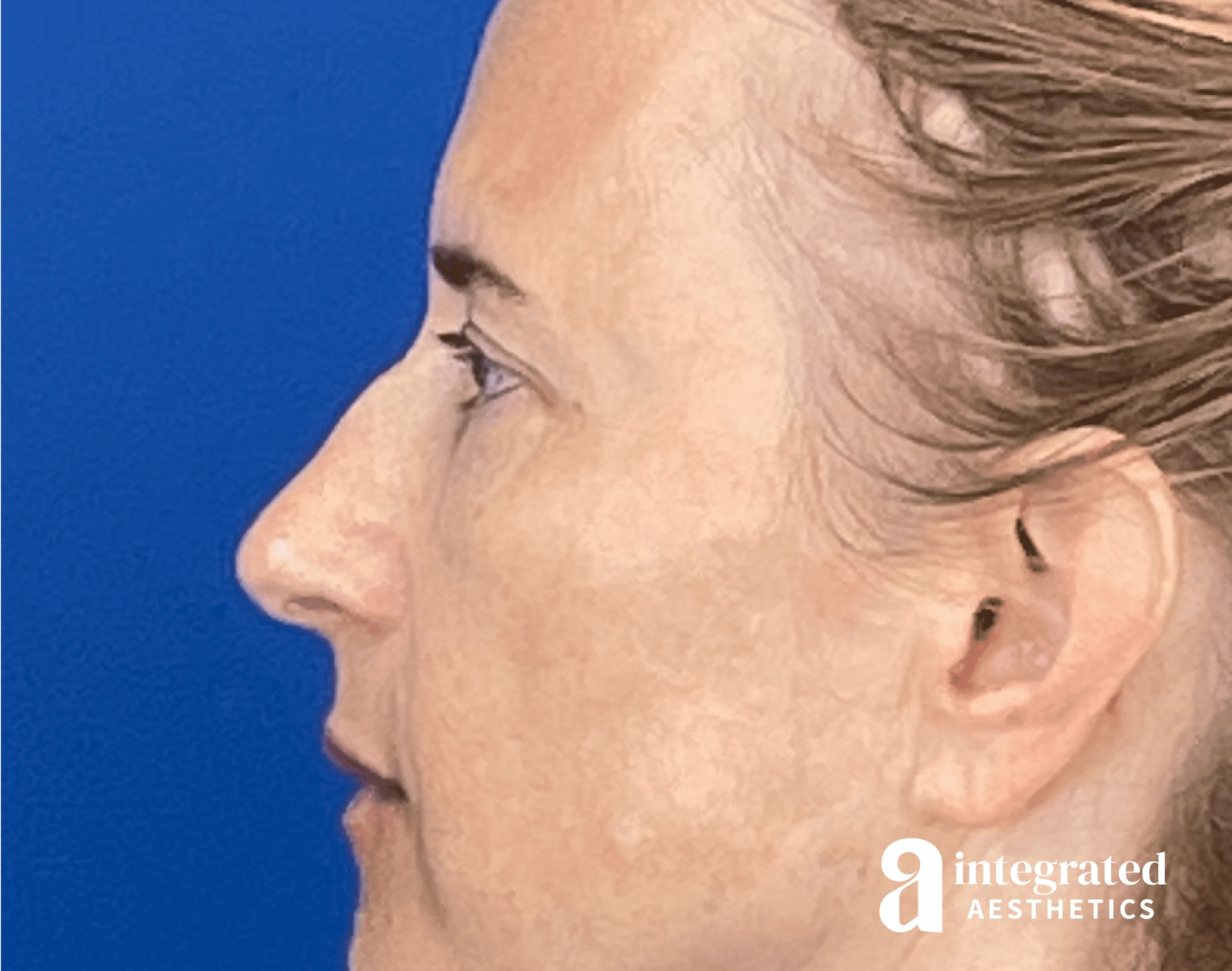 Dermal Fillers Before & After Gallery - Patient 421717 - Image 1