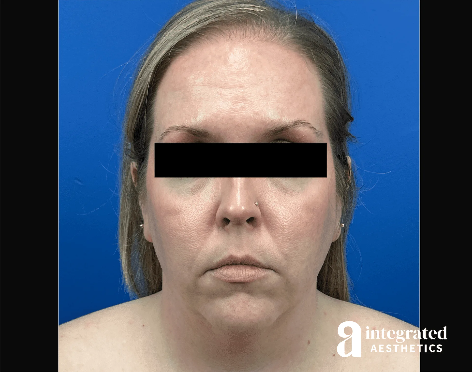 Facelift & Neck Lift