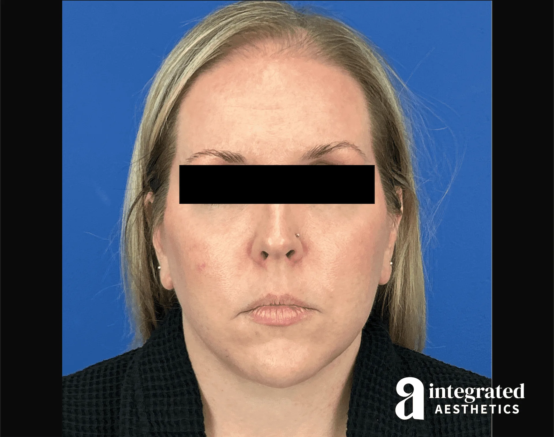 Facelift & Neck Lift