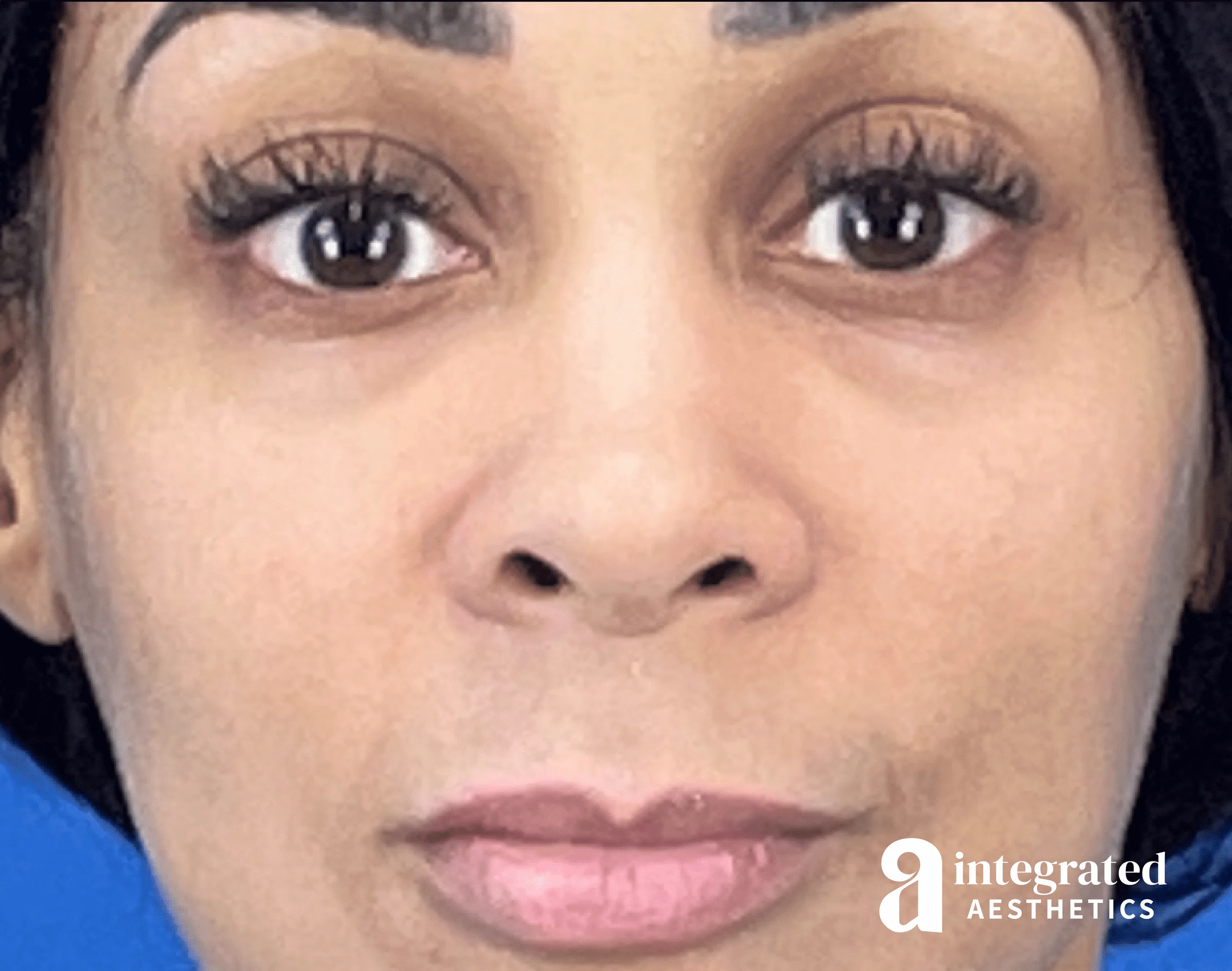 Resolved Aesthetic Complications