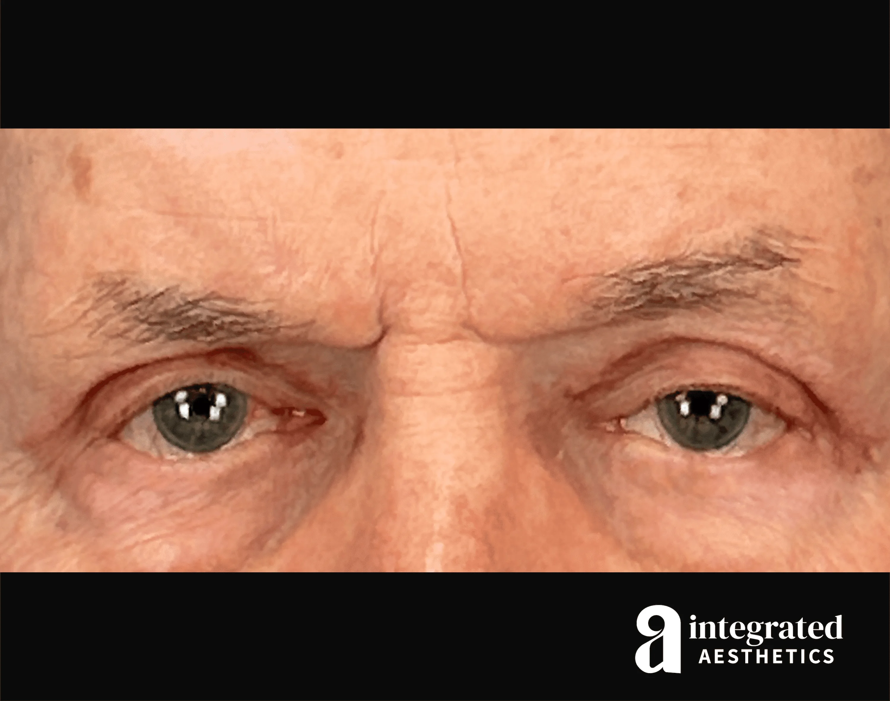 Blepharoplasty