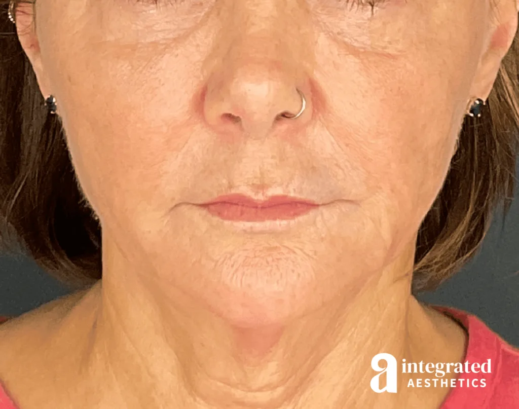Sculptra