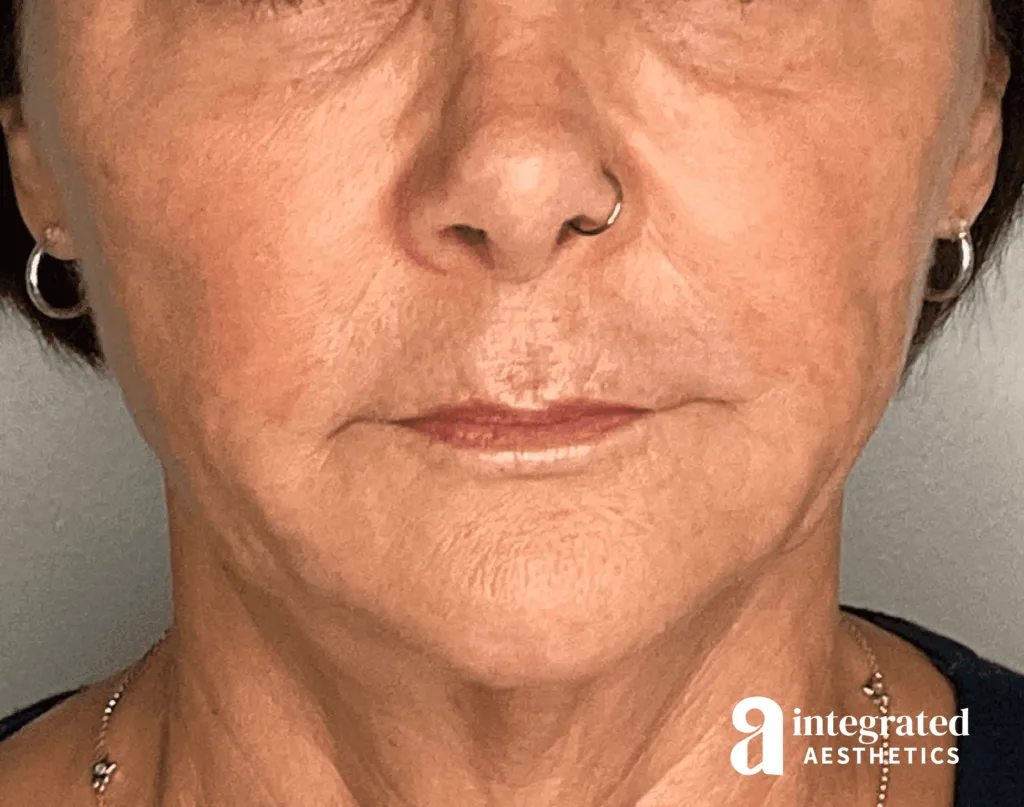 Sculptra
